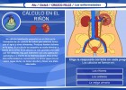 El cálculo en el riñón | Recurso educativo 36056