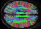 Scans reveal intricate brain wiring | Recurso educativo 746709